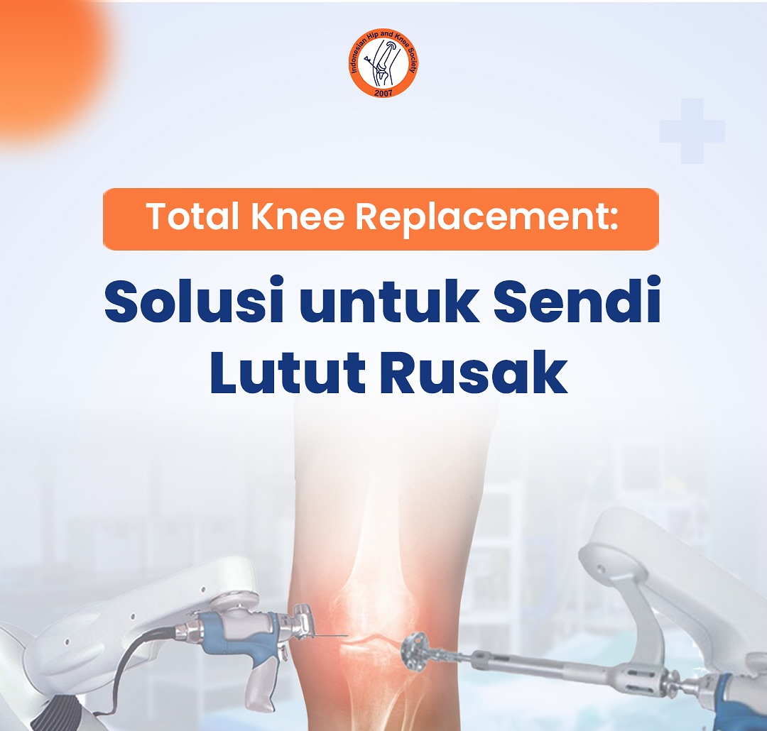 Total Knee Replacement: Solusi untuk Sendi Lutut Rusak