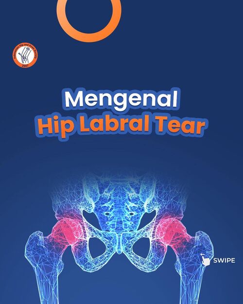 Hip Labral Tear