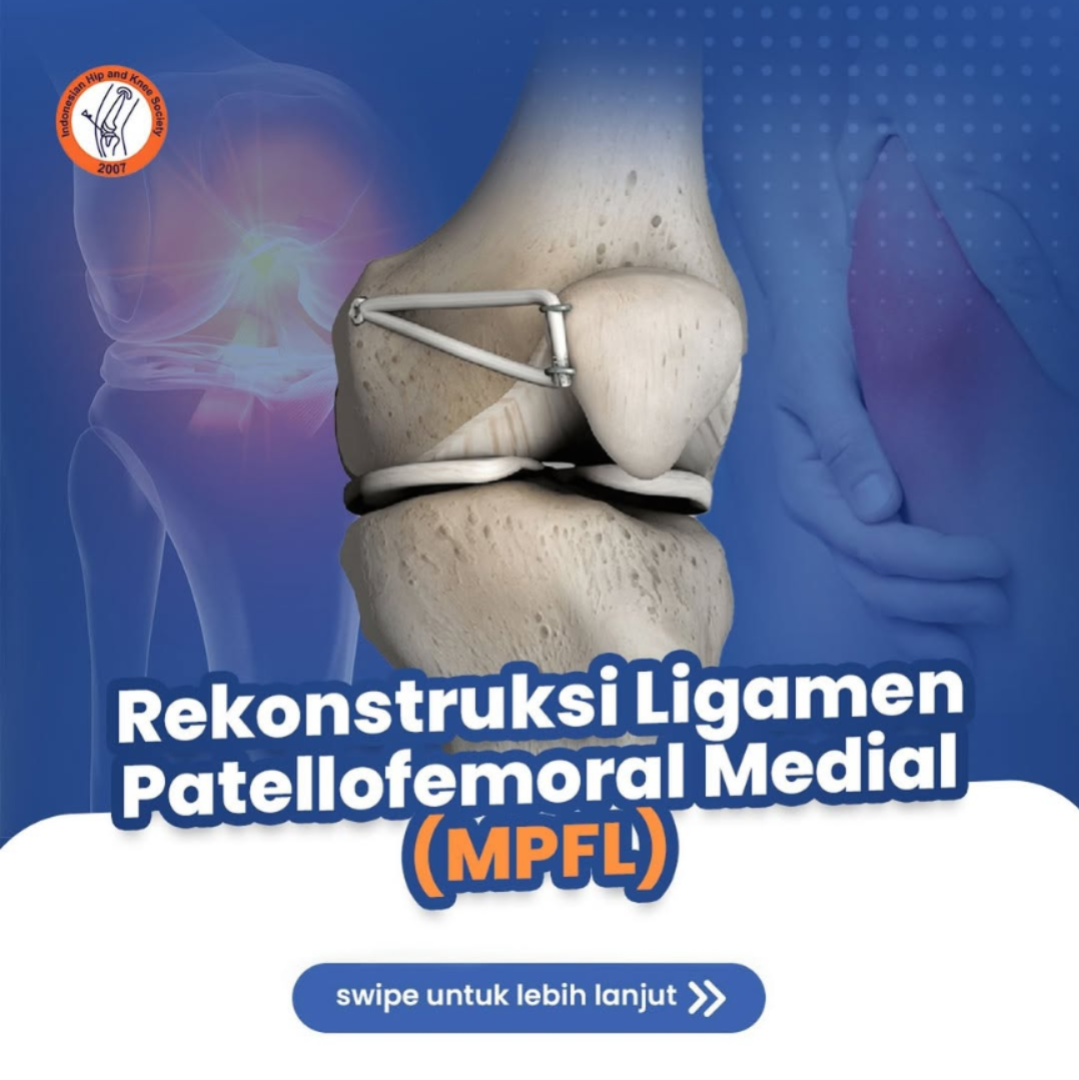 Rekonstruksi Ligamen Patellofemoral Medial (MPFL)